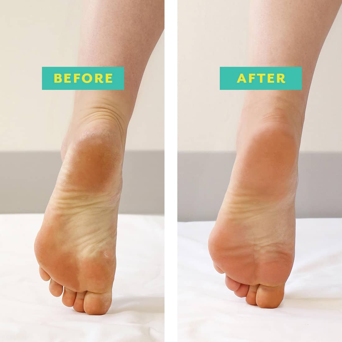 PoshPeel™ Pedi Cure | Patchology