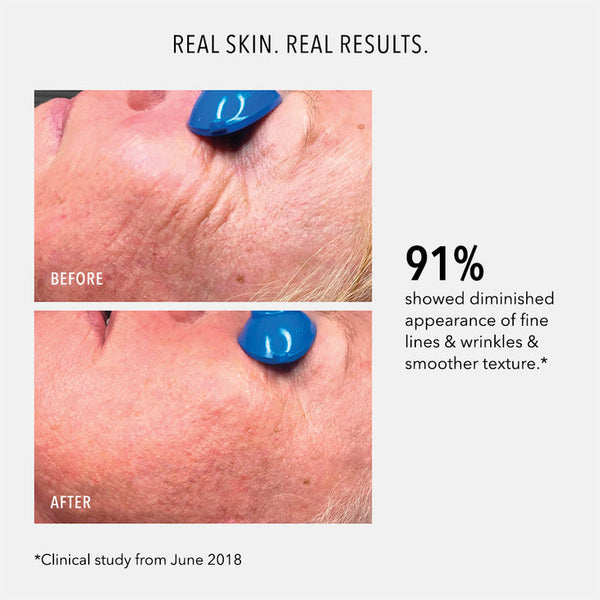Before and after close-up images showing reduced fine lines and wrinkles on facial skin, demonstrating effectiveness of Nimni Cream .5 oz | HydroPeptide skincare product.