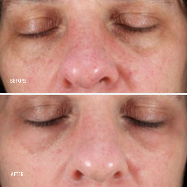 Before and after close-up images of a person's face showing reduced redness and improved skin tone after using Nimni Cream .5 oz | HydroPeptide for skincare.