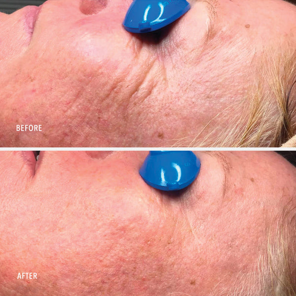 Close-up comparison showing reduced wrinkles and smoother skin on a person's face before and after using Nimni Cream .5 oz | HydroPeptide in a skincare treatment.