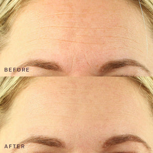 Close-up comparison of a forehead showing reduced wrinkles and smoother skin in the after photo, highlighting the effects of Ageless Beauty Bundle | Dermaclara skincare treatment.