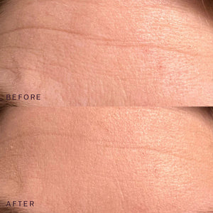 Close-up comparison of forehead skin showing reduced wrinkles and smoother texture after using the Ageless Beauty Bundle | Dermaclara skincare product.
