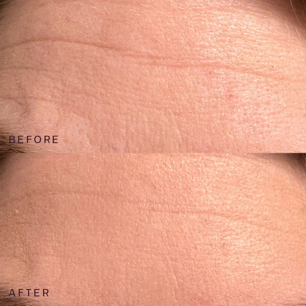 Close-up comparison of forehead skin showing reduced wrinkles and smoother texture after using the Ageless Beauty Bundle | Dermaclara skincare product.