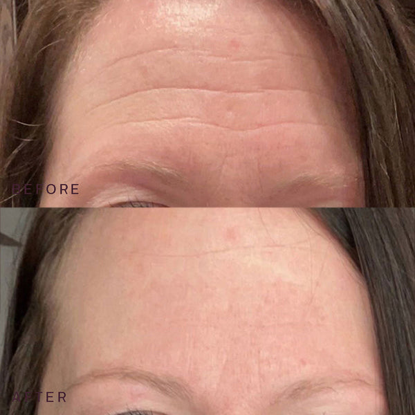 Before and after close-up comparison of a forehead showing reduced wrinkles and smoother skin after using the Face to Face Bundle | Dermaclara skincare product.