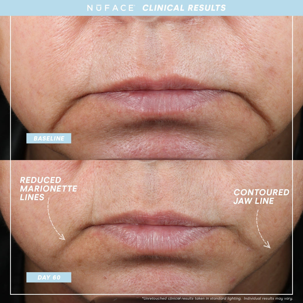 Auction - Nuface Trinity Plus Pro Device (Retail Value : $395)