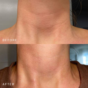 Close-up before and after comparison of a neck showing smoother, more hydrated skin, demonstrating the effects of the Ageless Beauty Bundle | Dermaclara skincare treatment.