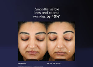 Before and after comparison showing reduction in visible lines and coarse wrinkles after 24 weeks using ProMax Age Renewal | PCA Skin, emphasizing skincare results.
