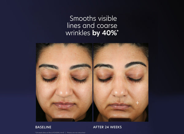 Before and after comparison showing reduction in visible lines and coarse wrinkles after 24 weeks using ProMax Age Renewal | PCA Skin, emphasizing skincare results.