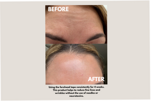 Forehead Tape – Wrinkle Smoothing Patches | Seald™ Wellness